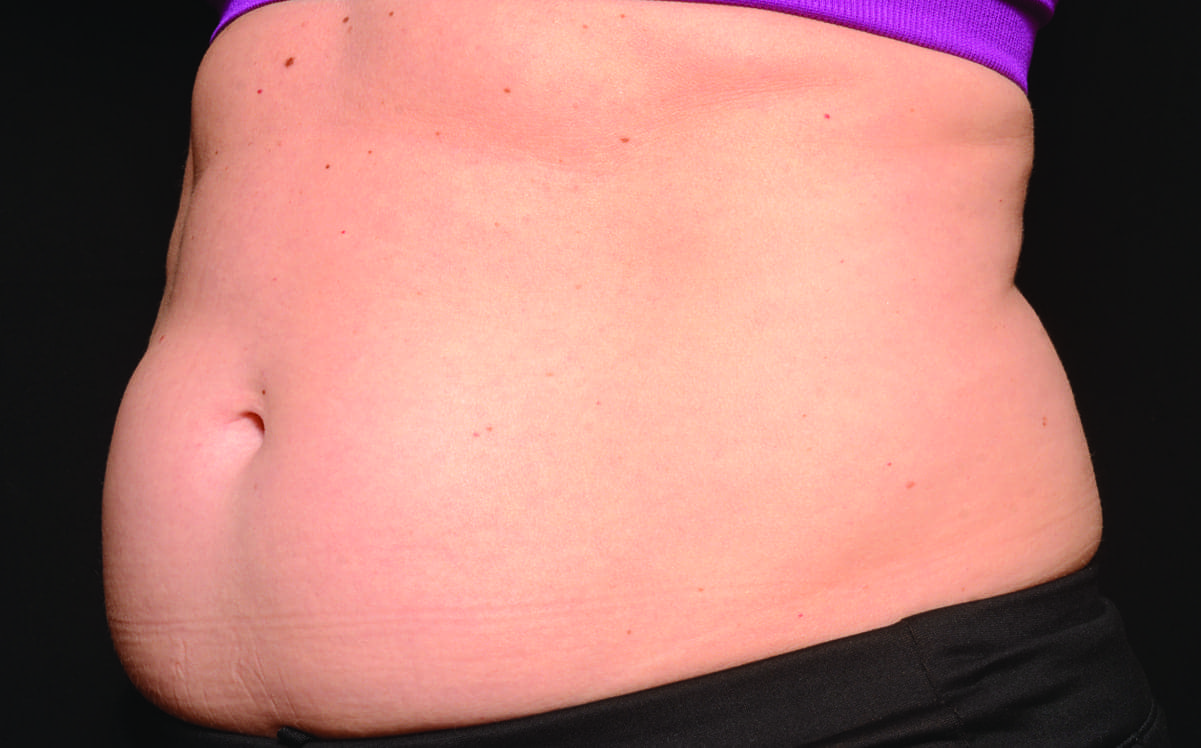 Abdomen_Female3_Before.jpg