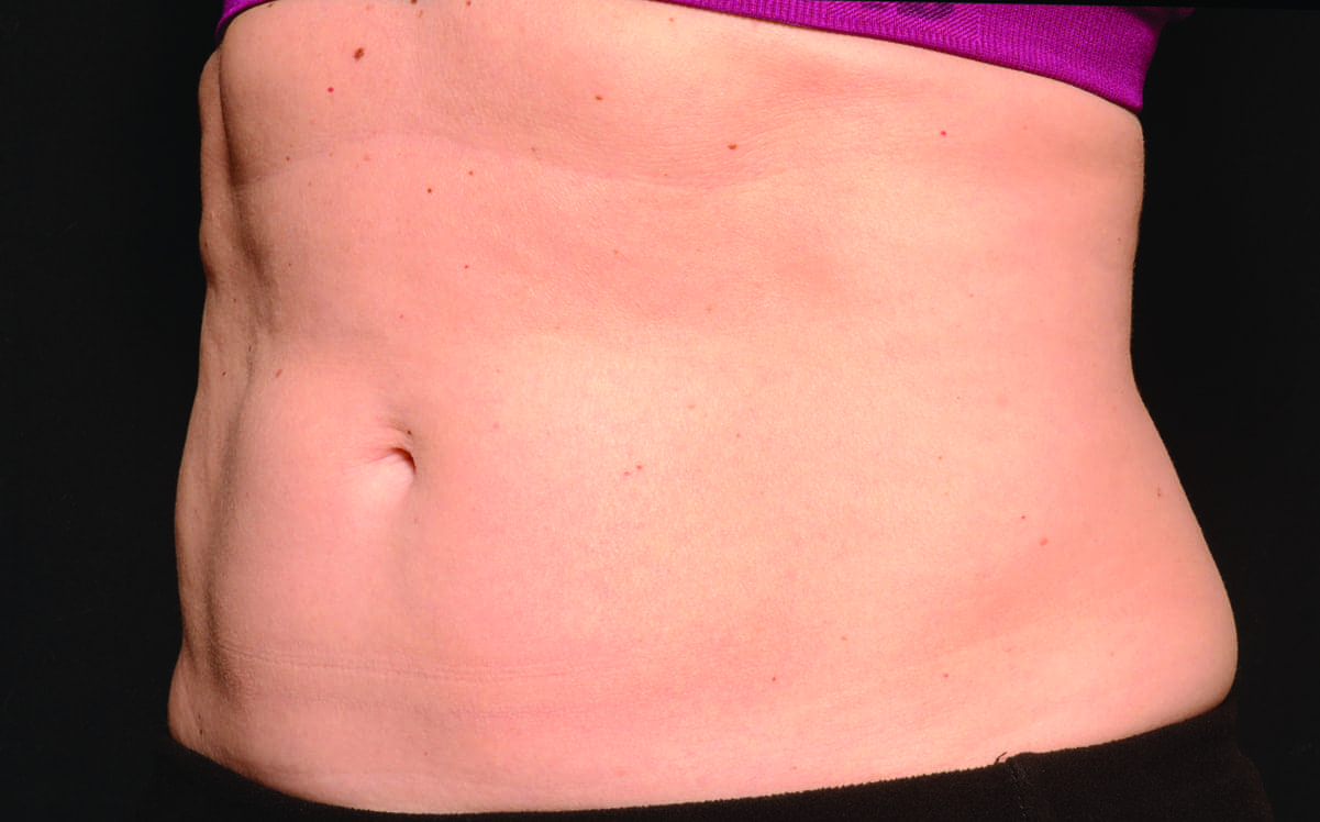 Abdomen_Female4_After.jpg