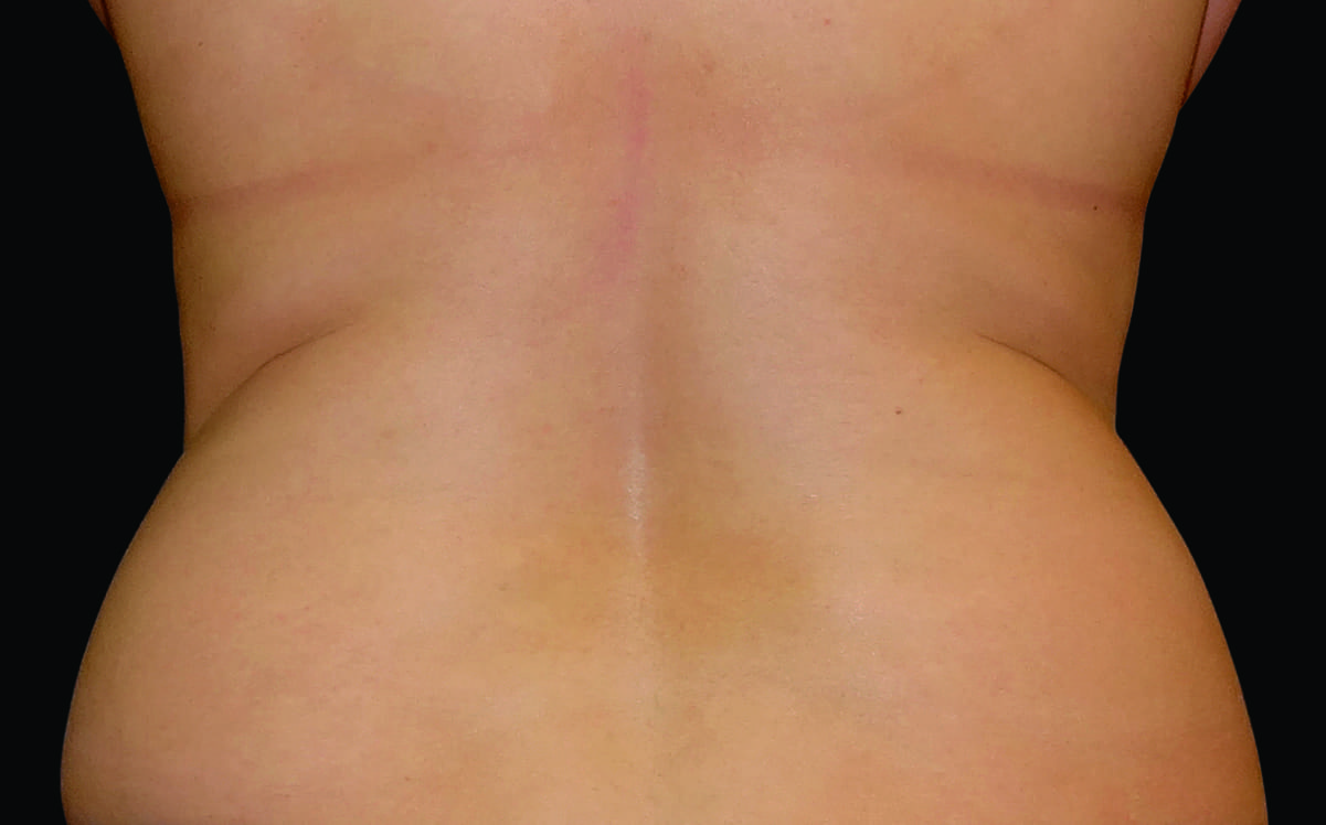 Flank_Female1_Before.jpg