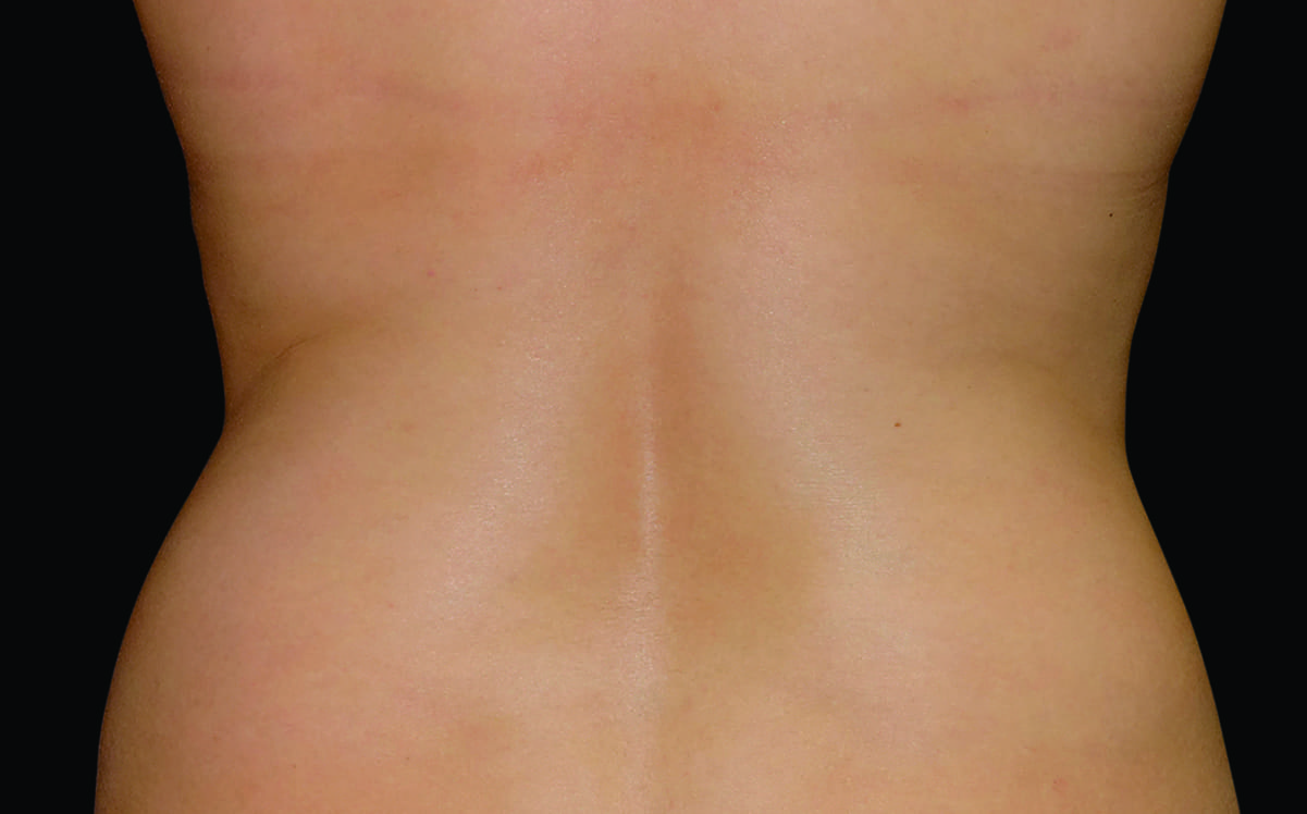 Flank_Female2_After.jpg