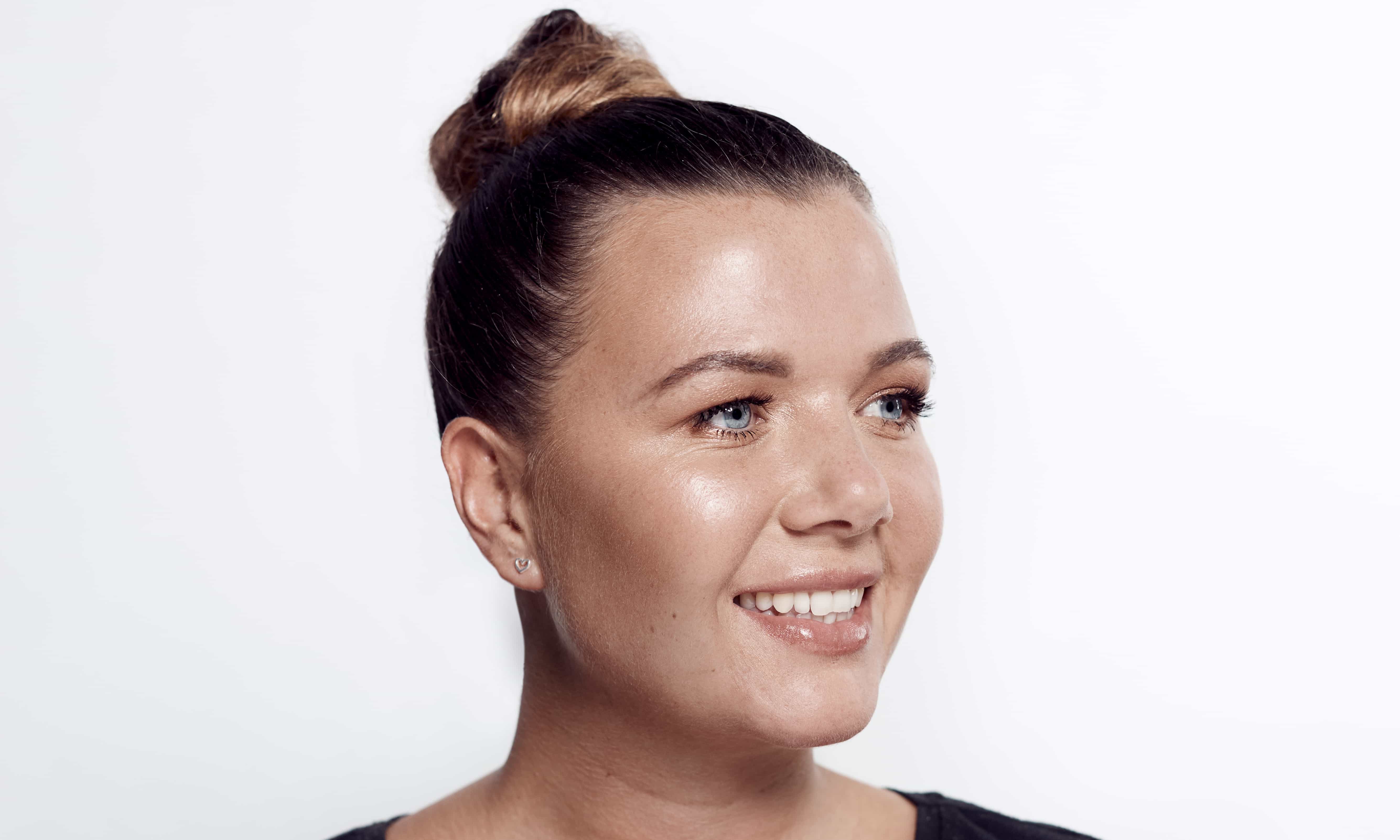 Female-dermal-filler-after-right.jpg