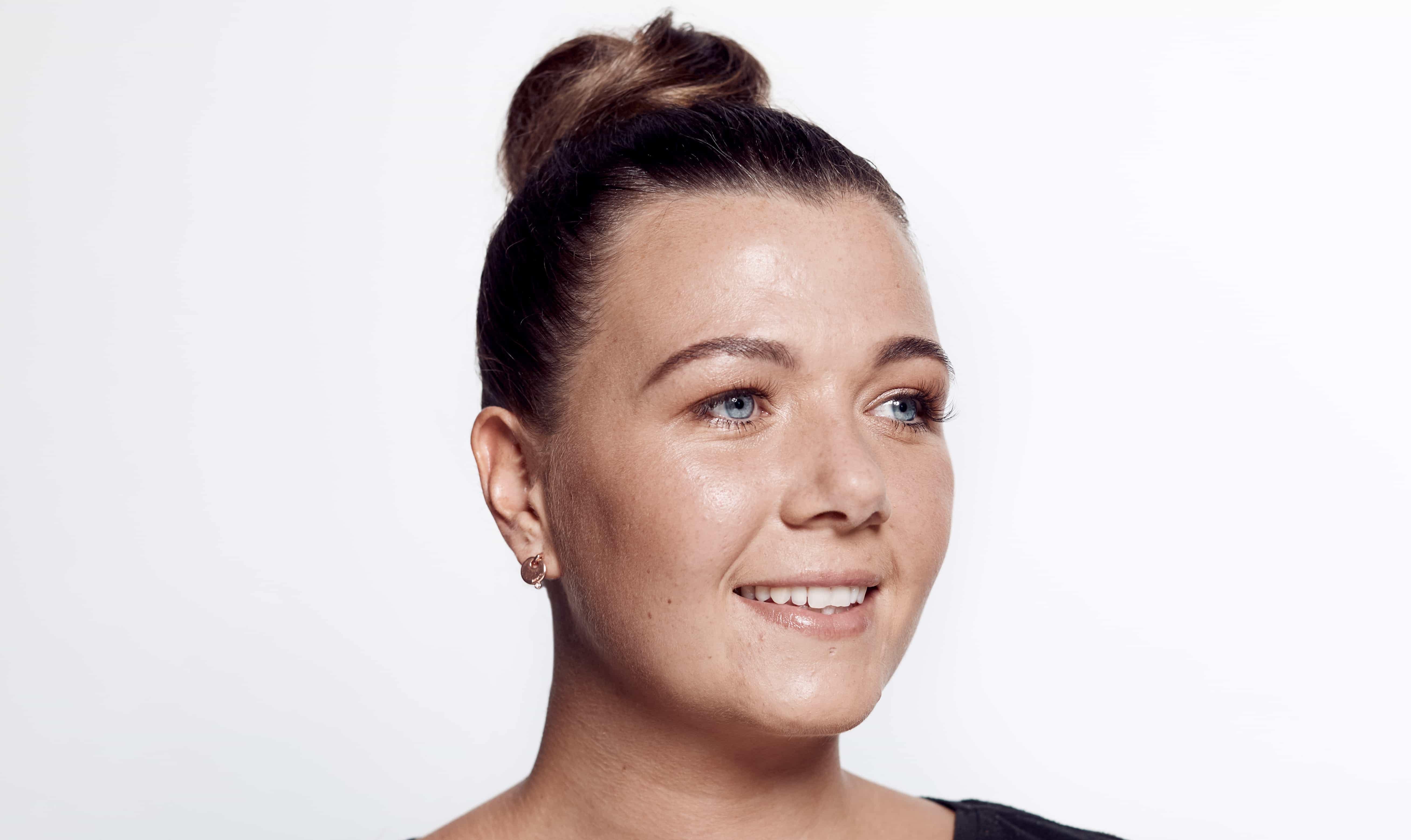 Female-dermal-filler-before-right1.jpg