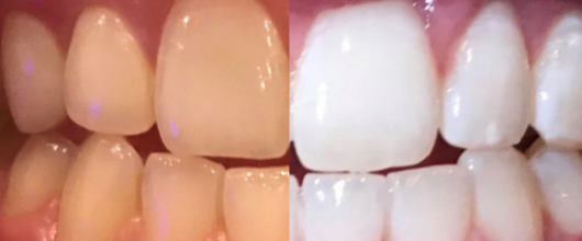 teethb&a.png