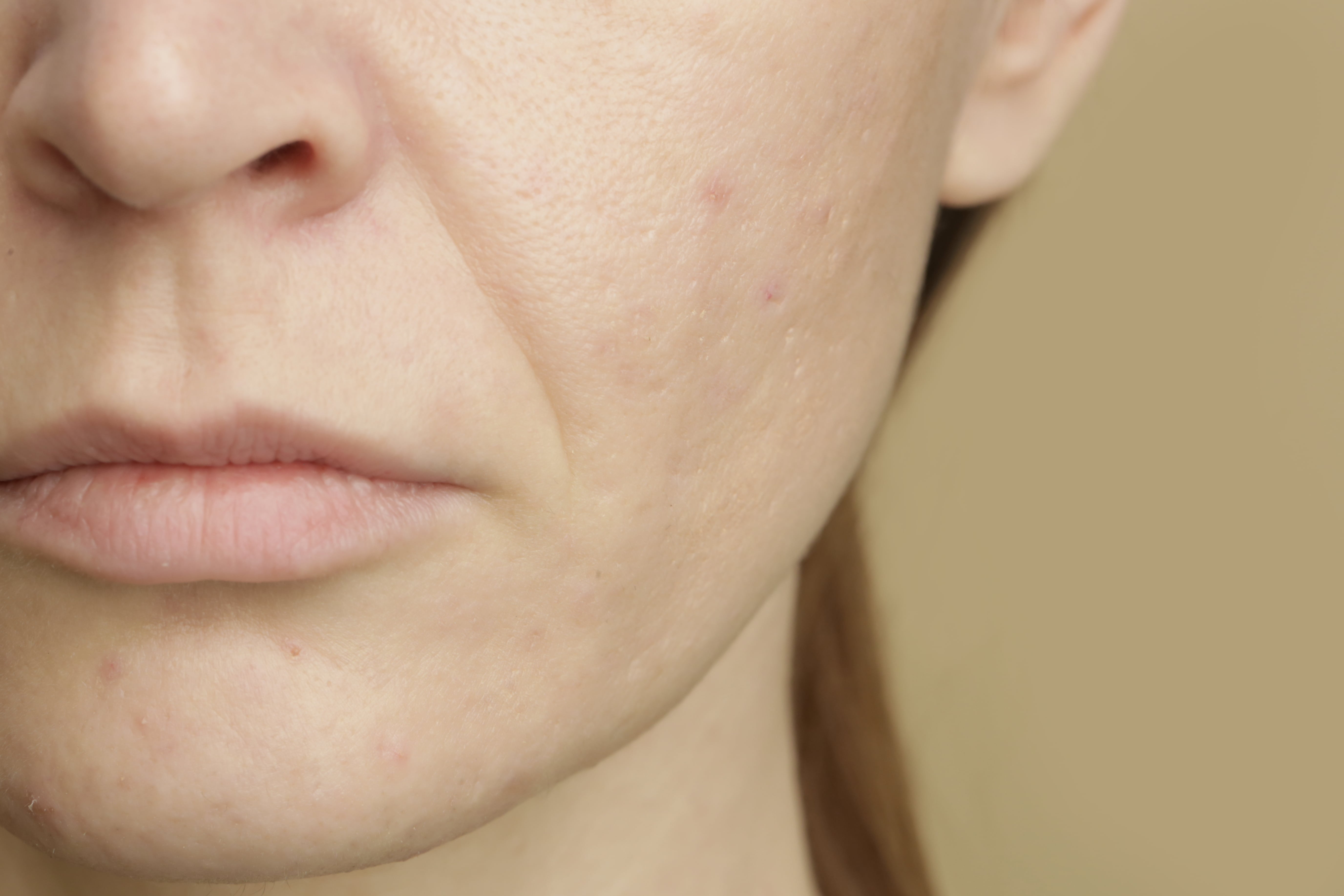 Enlarged Pores-min.jpg