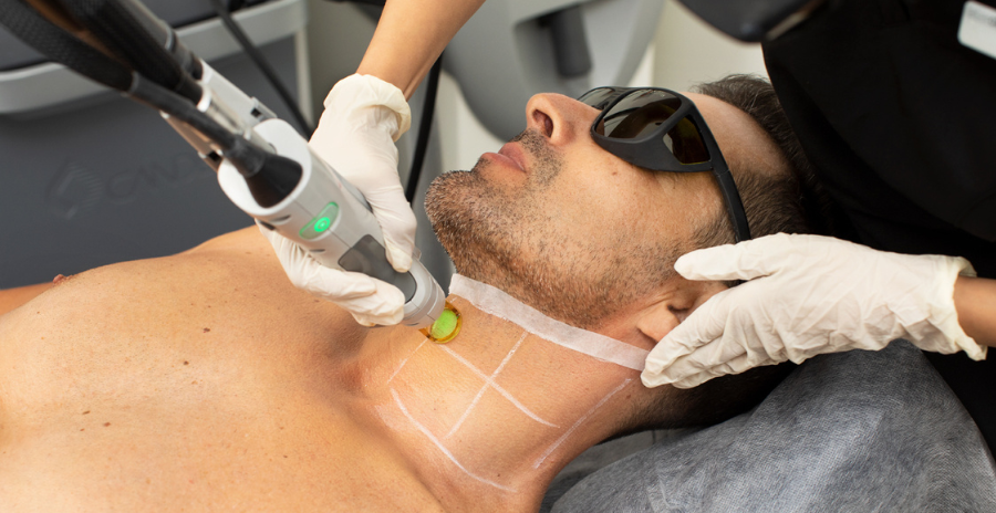  Laser Hair Removal