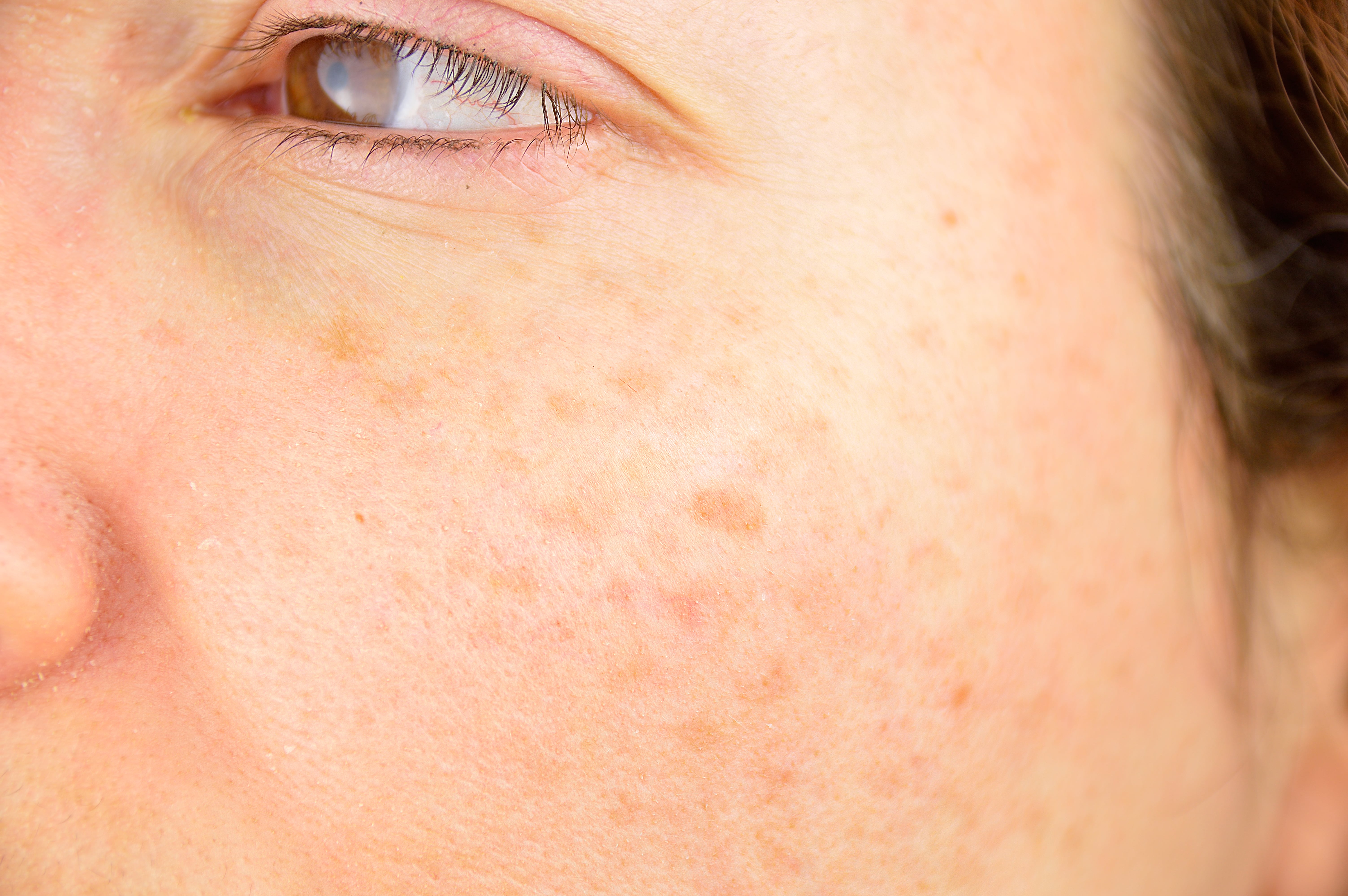 Pigmentation-min.jpg