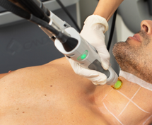 Laser Hair Removal