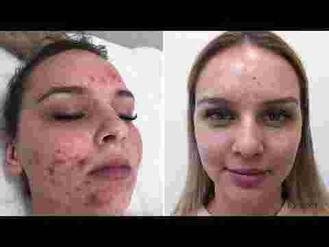 Kleresca® Acne - the revolutionary skin treatment for acne and acne scarring 