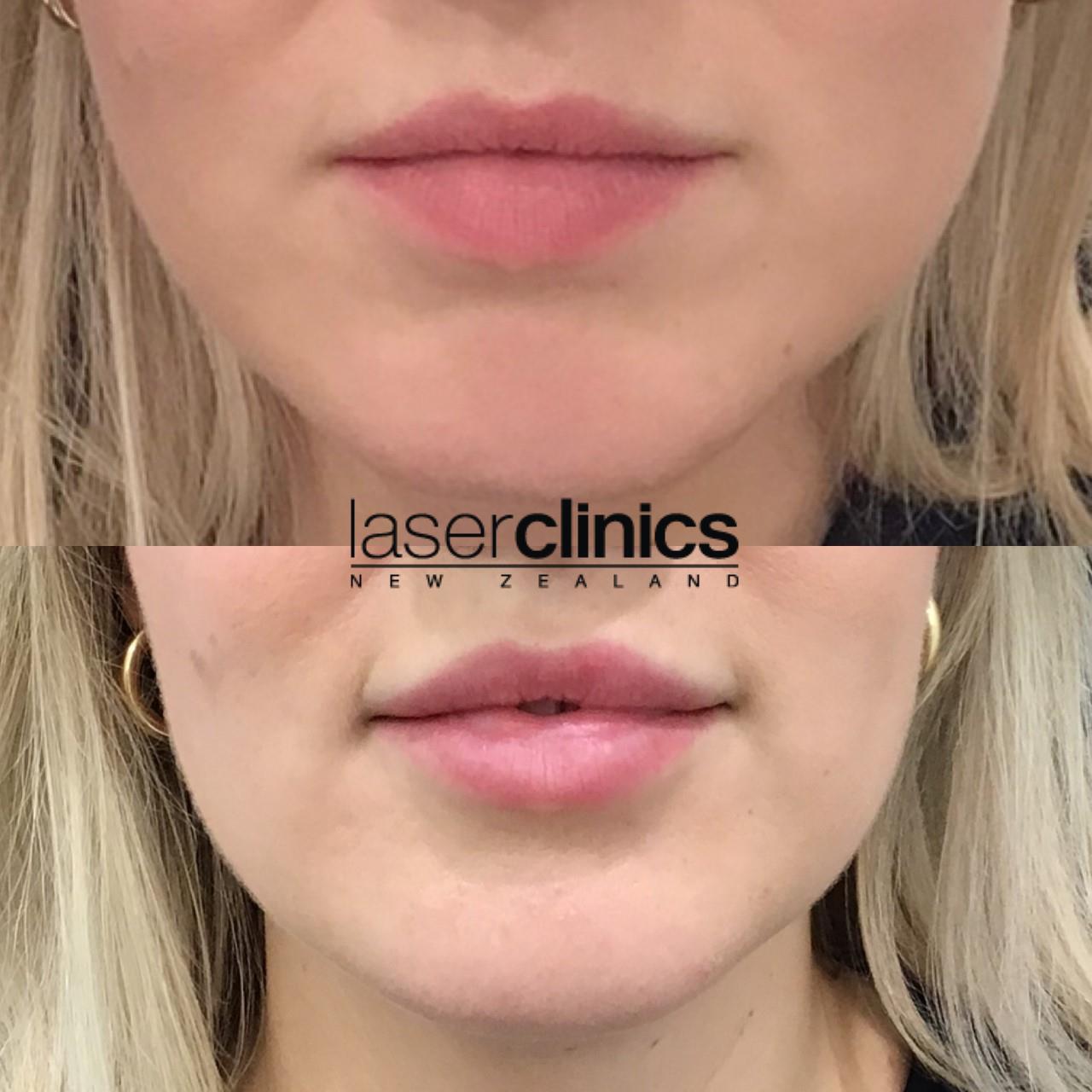 Cosmetic Injectables - Before and After | Laser Clinics Australia